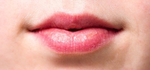 Lippen um roter rand Lippenentzündung